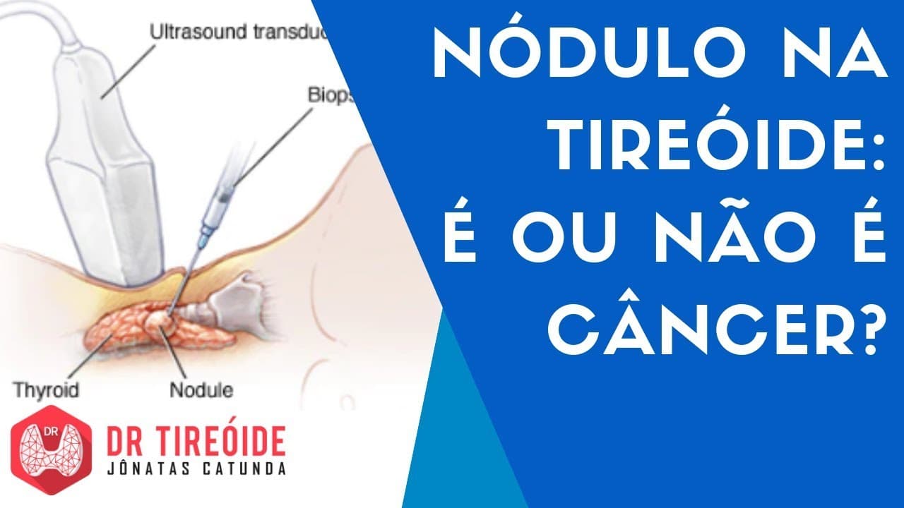 Nódulo na tireóide: é ou não é câncer? | Dr Tireóide Responde