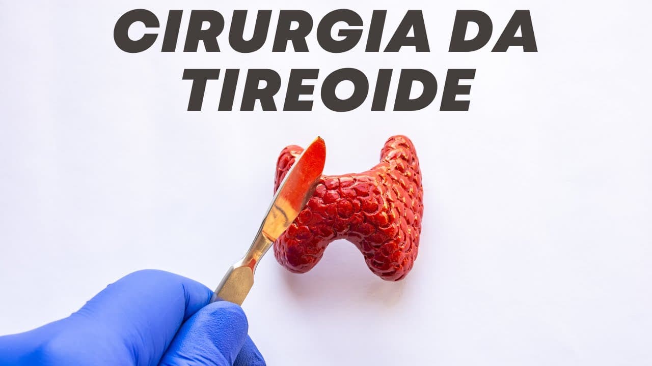 O que muda após a cirurgia da tireoide? - Live respondendo perguntas