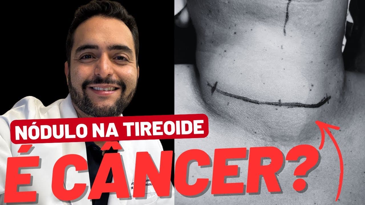 Bethesda 2: por que alguns nódulos benignos ainda precisam de cirurgia?