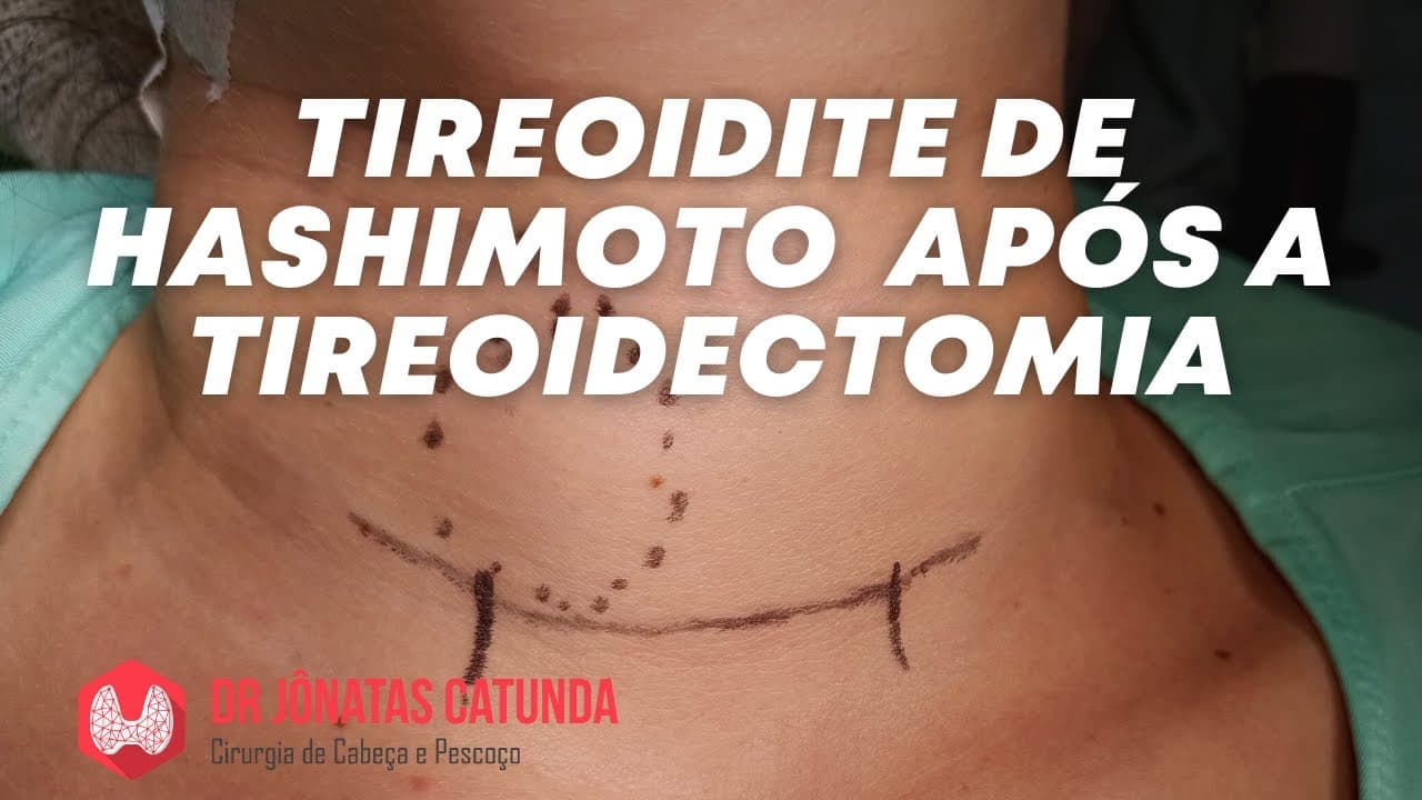 Tireoidite de Hashimoto após a cirurgia da tireoide