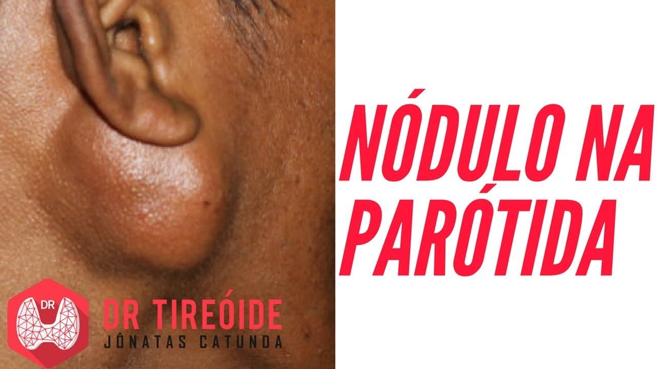 Nódulo na parótida - Sintomas, Diagnóstico e Tratamento - Parotidectomia!