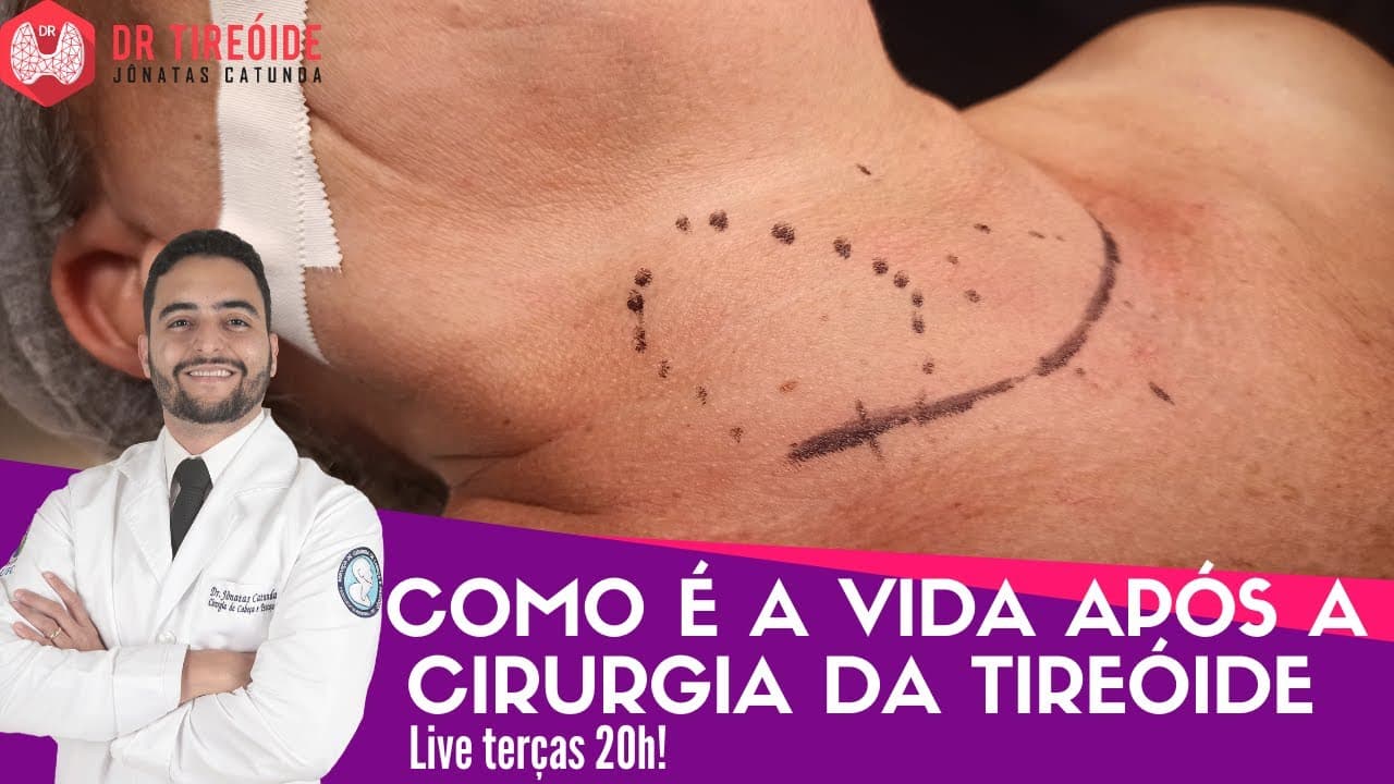 Como é a vida após a cirurgia da tireóide - LIVE Dr Tireóide responde