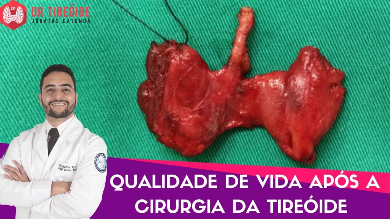 Existe qualidade de vida após a cirurgia da tireóide?