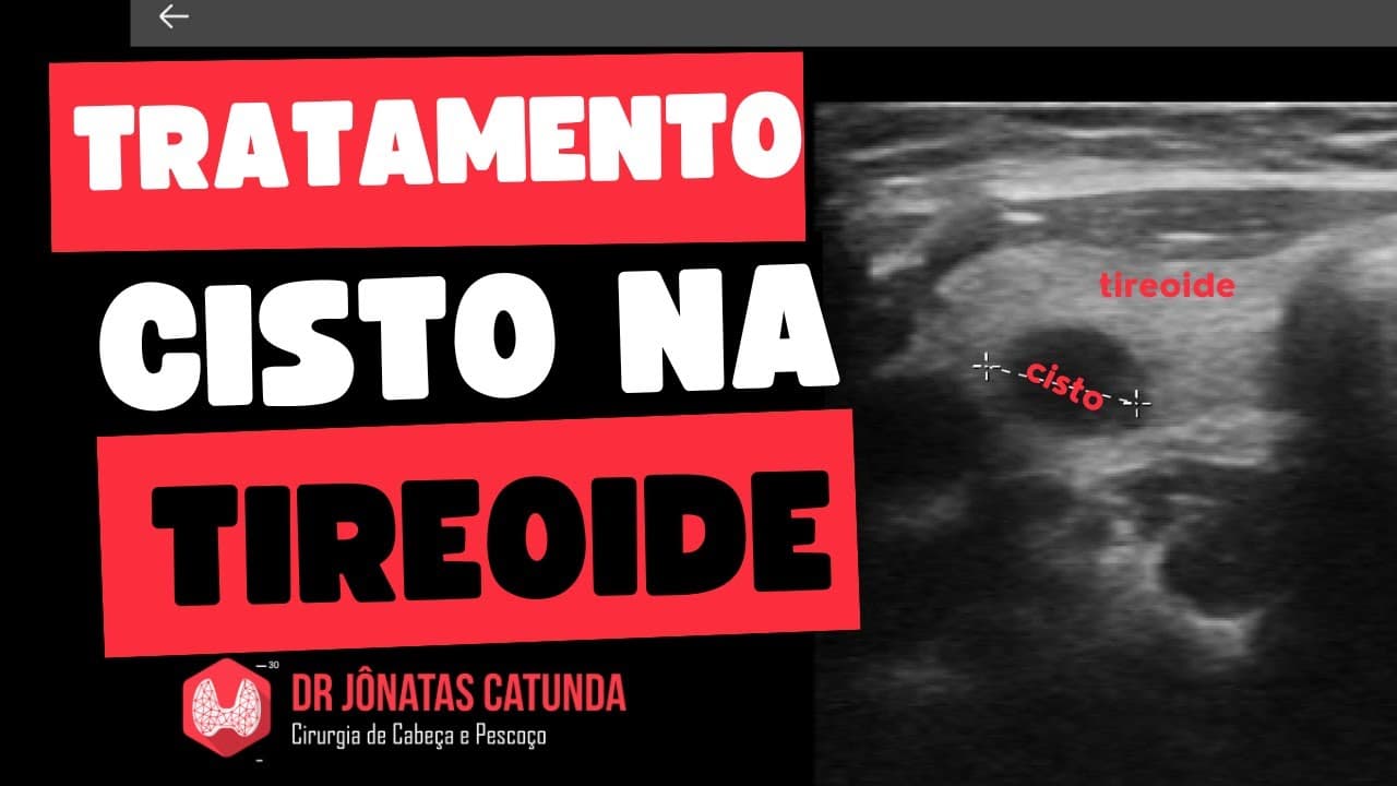 Tratamento do cisto na tireoide - Respondendo perguntas ao vivo