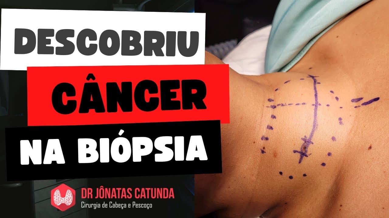 Carcinoma papilífero da tireoide descoberto após a tireoidectomia - Achado incidental de câncer
