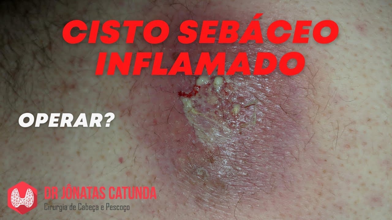 Cisto sebáceo - tratamento com cirurgia após desinflamar