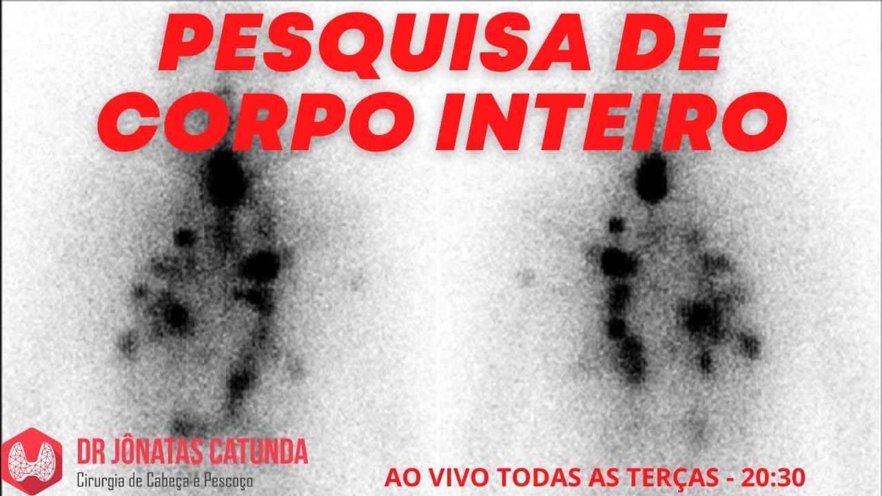 Pesquisa de corpo inteiro - PCI, iodoterapia, câncer de tireoide