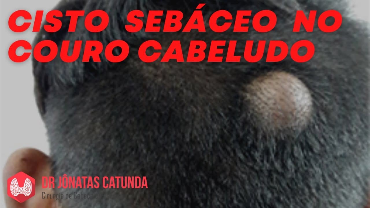 Cisto sebáceo no couro cabeludo: nasce cabelo depois?