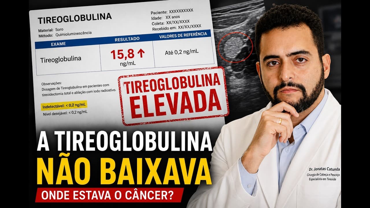 A tireoglobulina não baixava: encontramos a metástase escondida