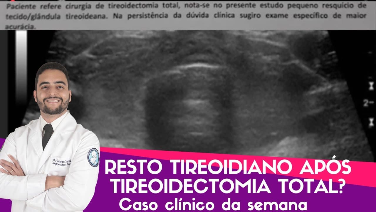 Resto tireoidiano após a tireoidectomia total - Caso clínico da semana