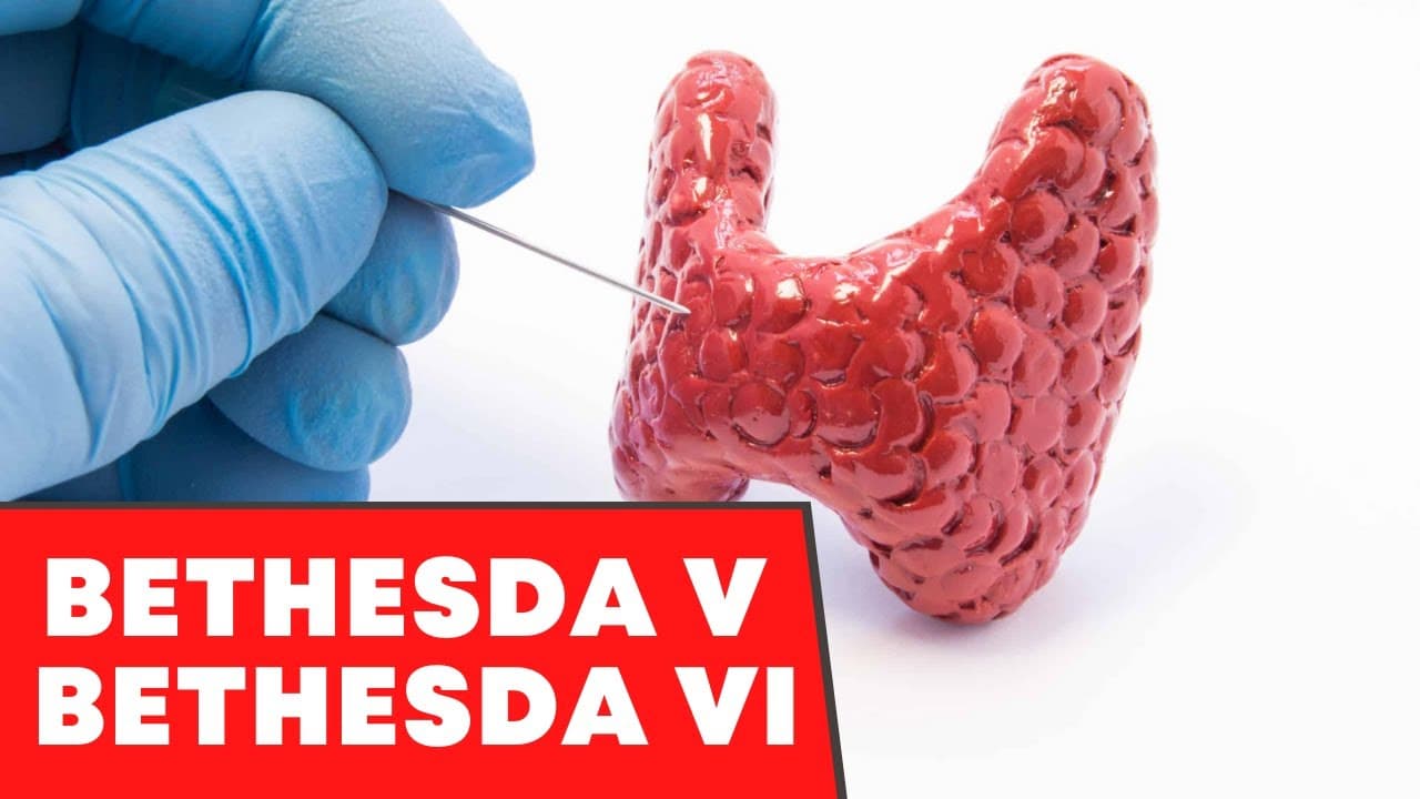Resultados Bethesda V ou VI na punção de tireoide - É câncer? Tem tratamento?