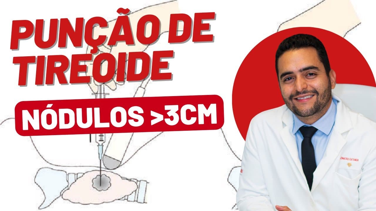 Nódulo Grande na Tireoide: Punção não é confiável!