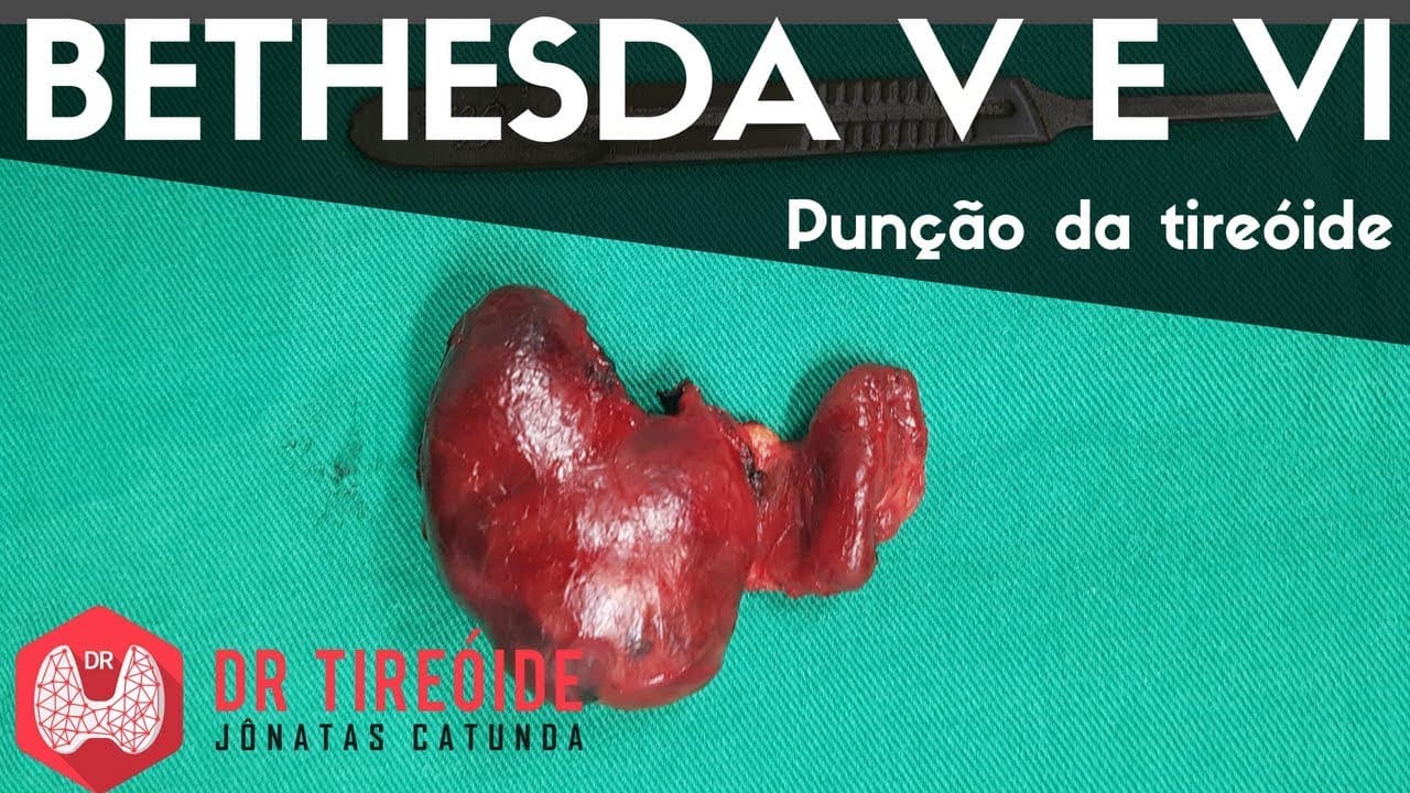 PAAF da tireóide Bethesda V e Bethesda VI - Carcinoma papilífero | Dr Jônatas Catunda