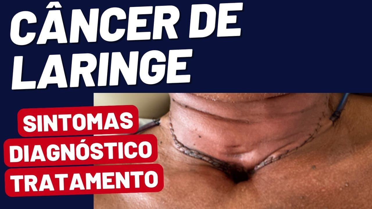 Câncer de Laringe: Como Reconhecer os Sintomas e Garantir o Tratamento Correto