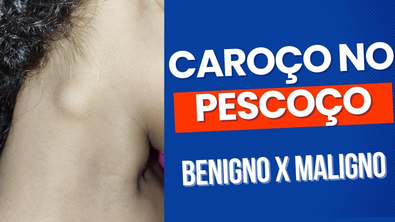Entenda mais sobre linfonodos no pescoço