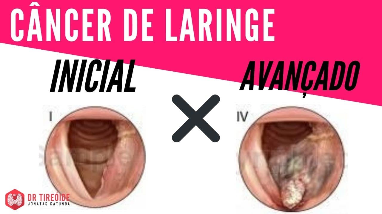 Diferenças do câncer de laringe em estágio inicial e avançado - Dr Jônatas Catunda