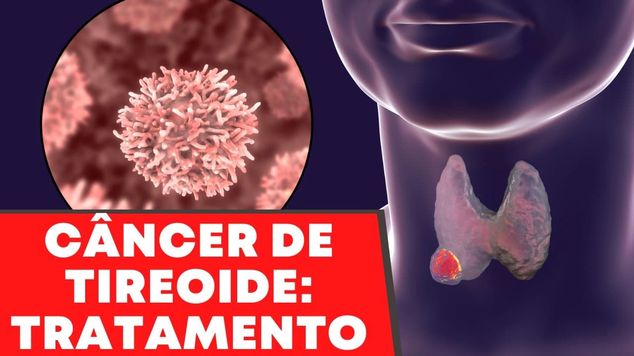 Etapas do tratamento do câncer de tireoide