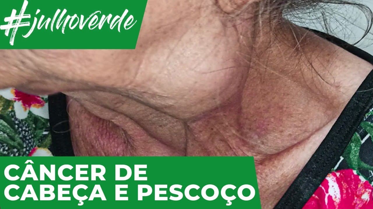 O que é o câncer de cabeça e pescoço? | Campanha Julho Verde