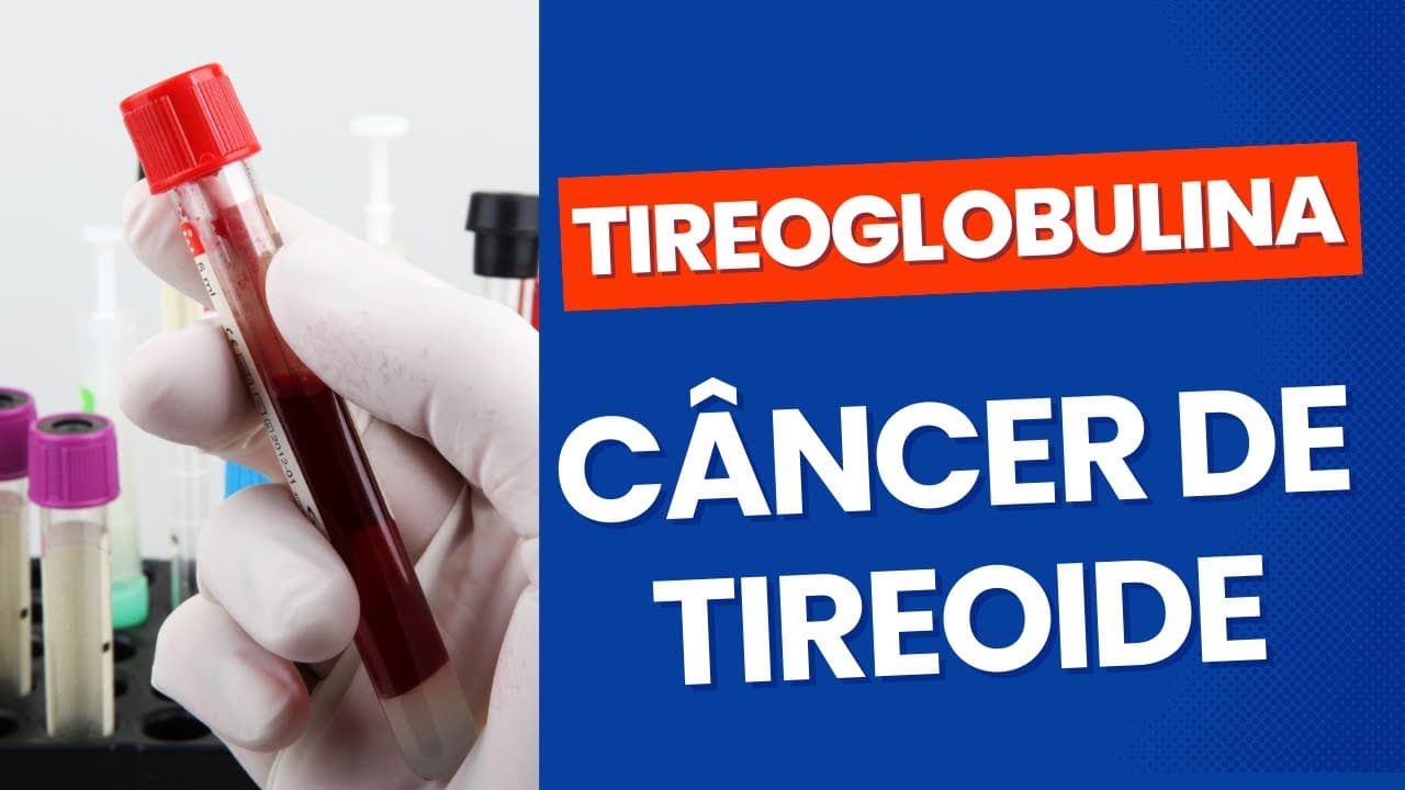 Tireoglobulina no seguimento do câncer