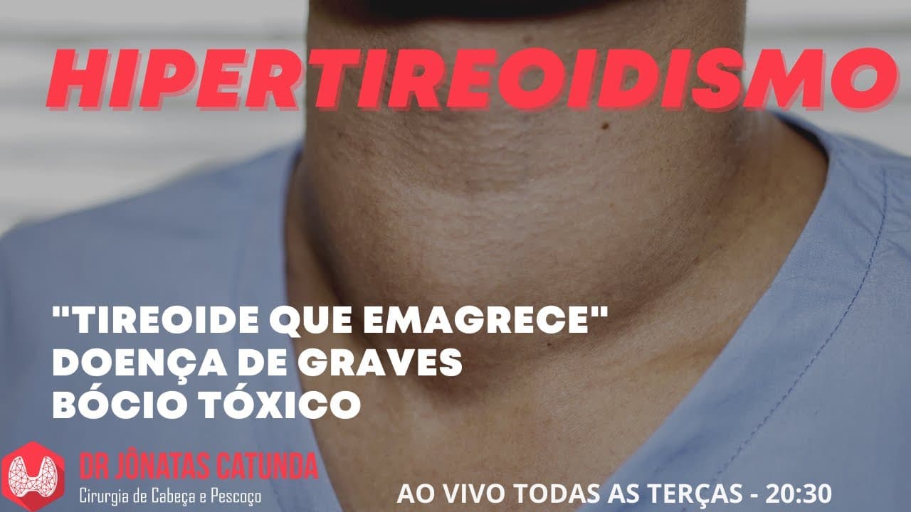 Hipertireoidismo - Ao vivo tirando dúvidas