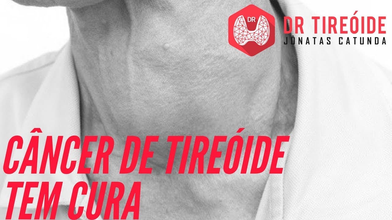 Câncer de tireóide tem cura? - O que todo mundo deveria saber! | Dr Jônatas Catunda