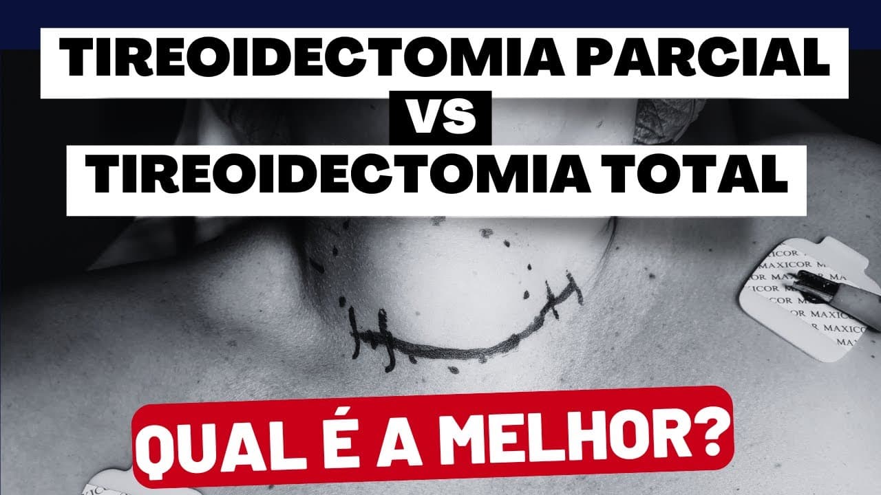 Tireoidectomia Total ou Parcial? Descubra Qual a Melhor Opção para o Seu Caso?