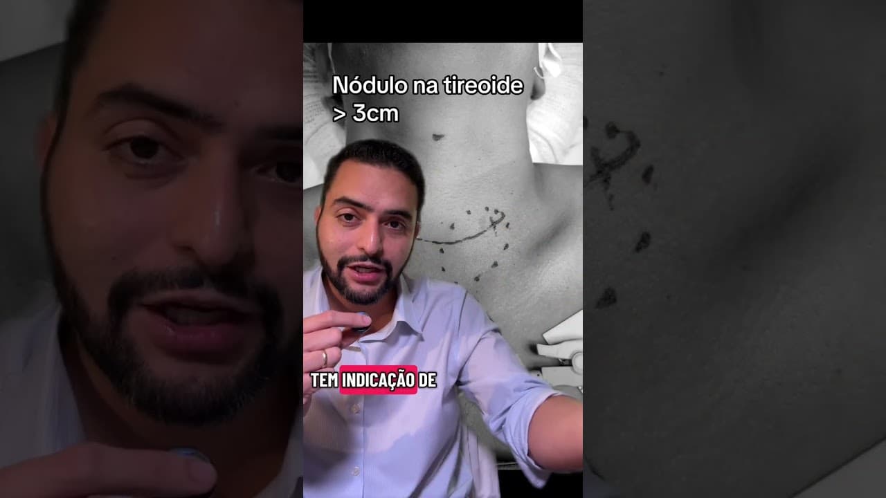 Nódulo de tireoide de 3 cm: por que operar mesmo sendo benigno