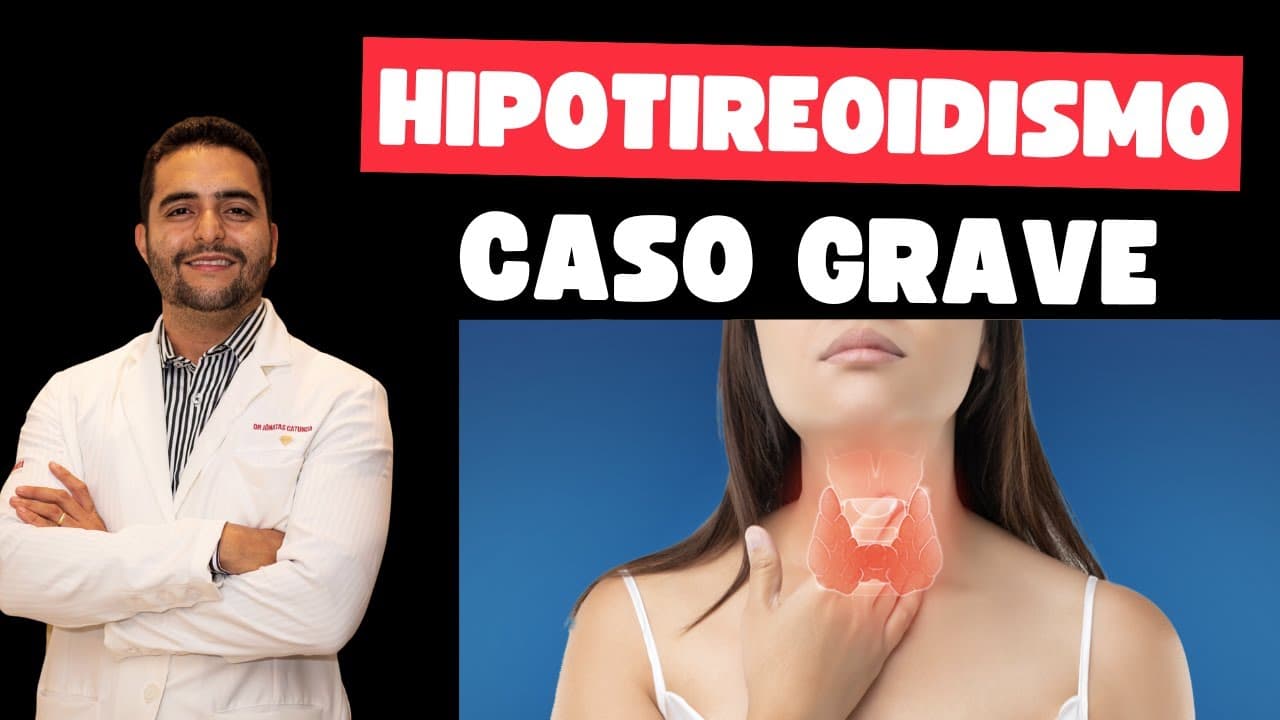 Hipotireoidismo grave - sintomas, exames, tratamento