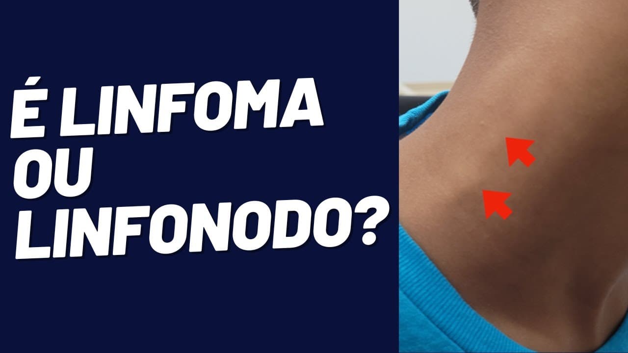Linfonodo no pescoço: É um linfoma ou algo benigno?