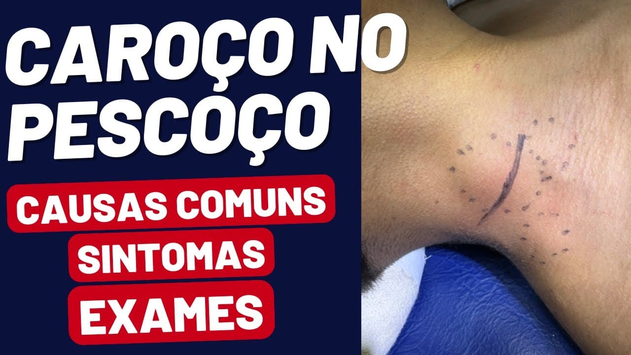 CAROÇO NO PESCOÇO: É GRAVE? Sintomas, Causas e Exames Explicados!