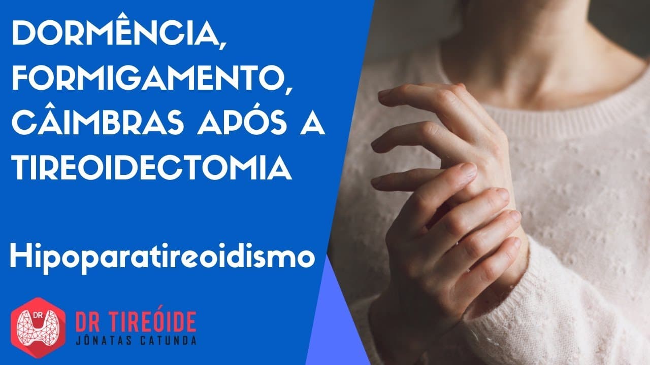 Dormência, Formigamento, Câimbra após a tireoidectomia - Dr Tireóide responde