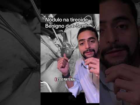 Nódulo de 3 cm na tireoide: operou metade e o resultado veio benigno