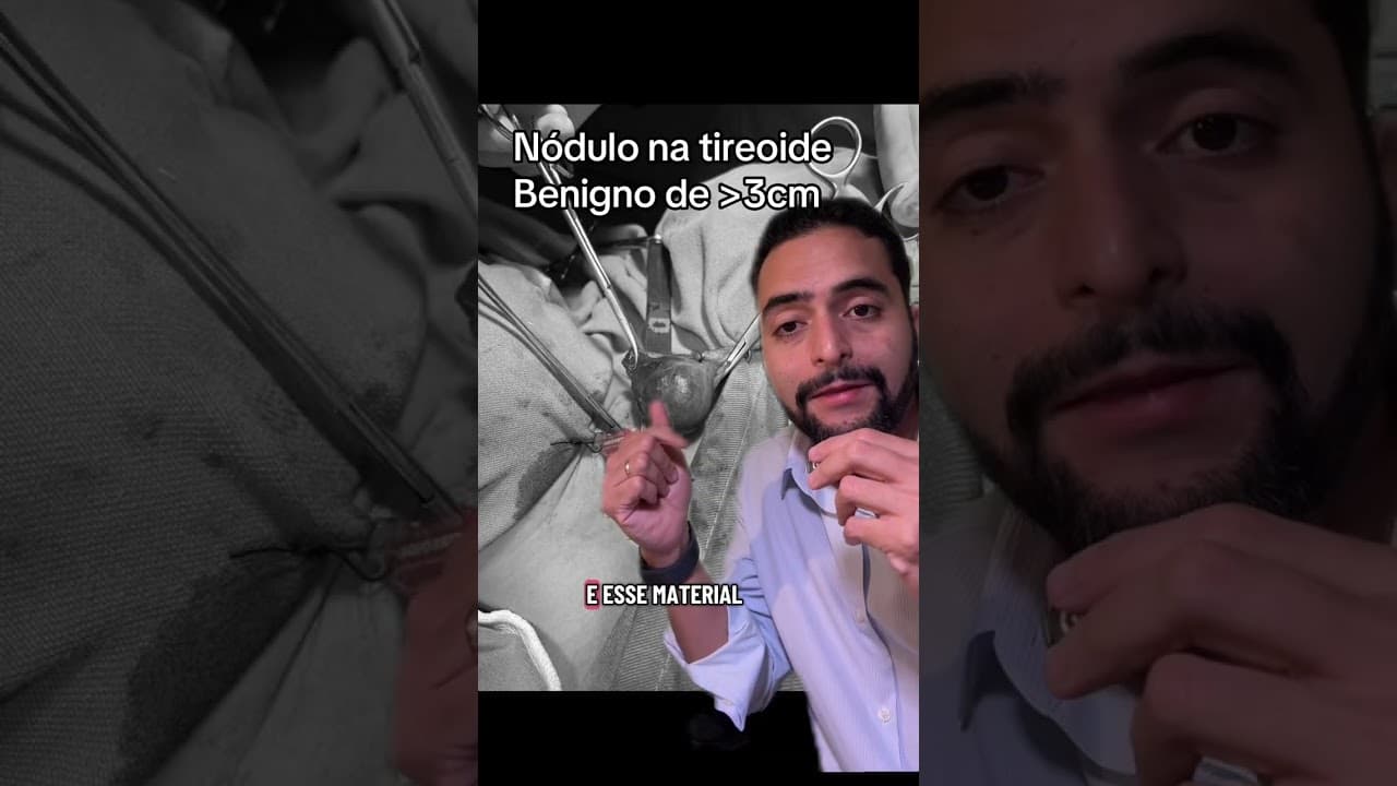 Nódulo de 3 cm na tireoide: operou metade e o resultado veio benigno