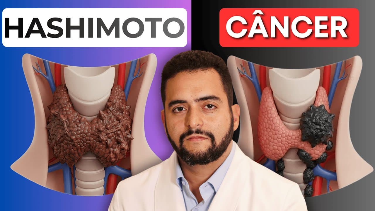 Tireoidite de Hashimoto e câncer de tireoide: qual é a relação?