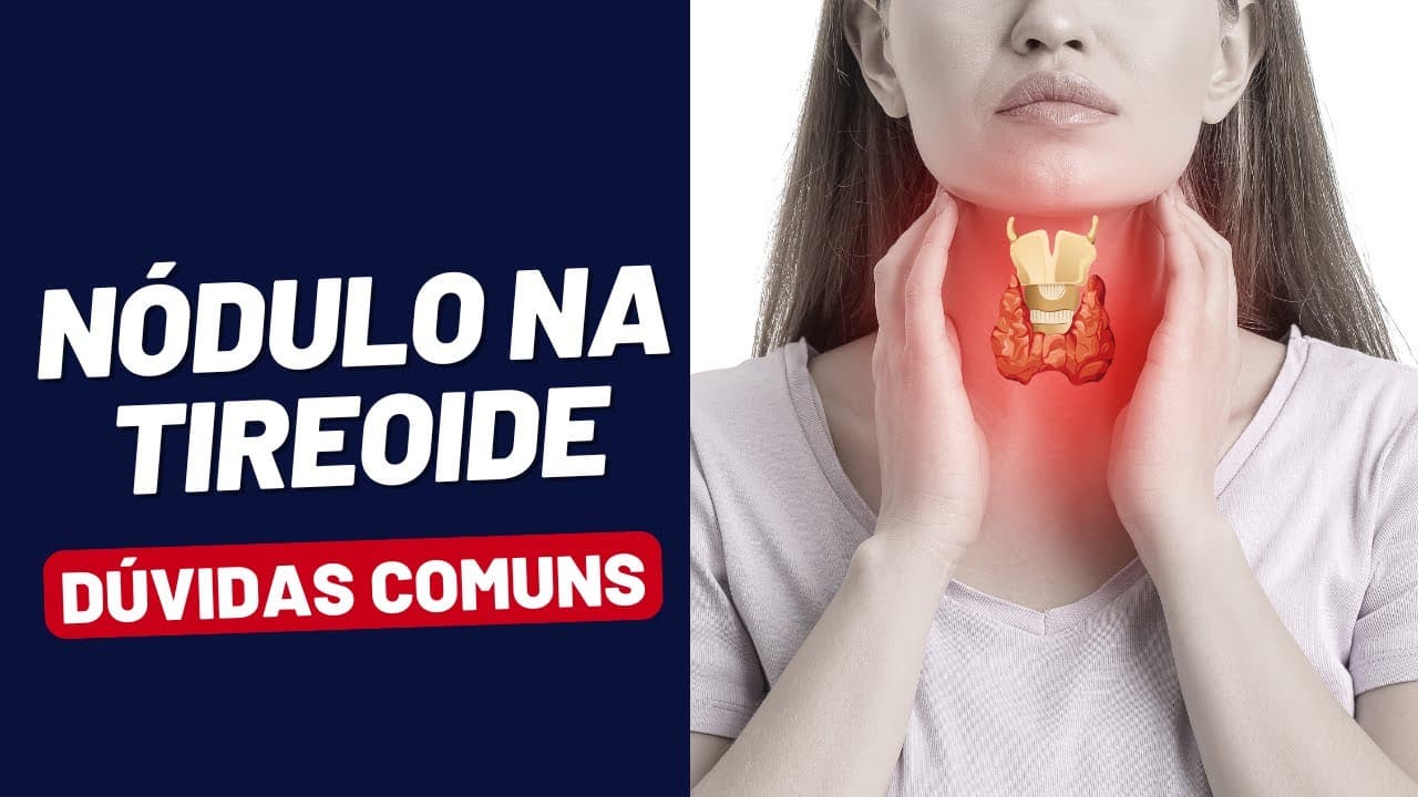 NODULO NA TIREOIDE - DÚVIDAS COMUNS