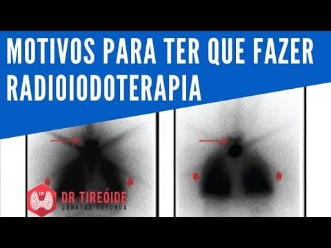 Motivos para ter que fazer radioiodoterapia - Dr Tireóide Responde