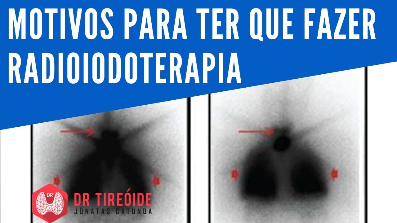 Motivos para ter que fazer radioiodoterapia - Dr Tireóide Responde