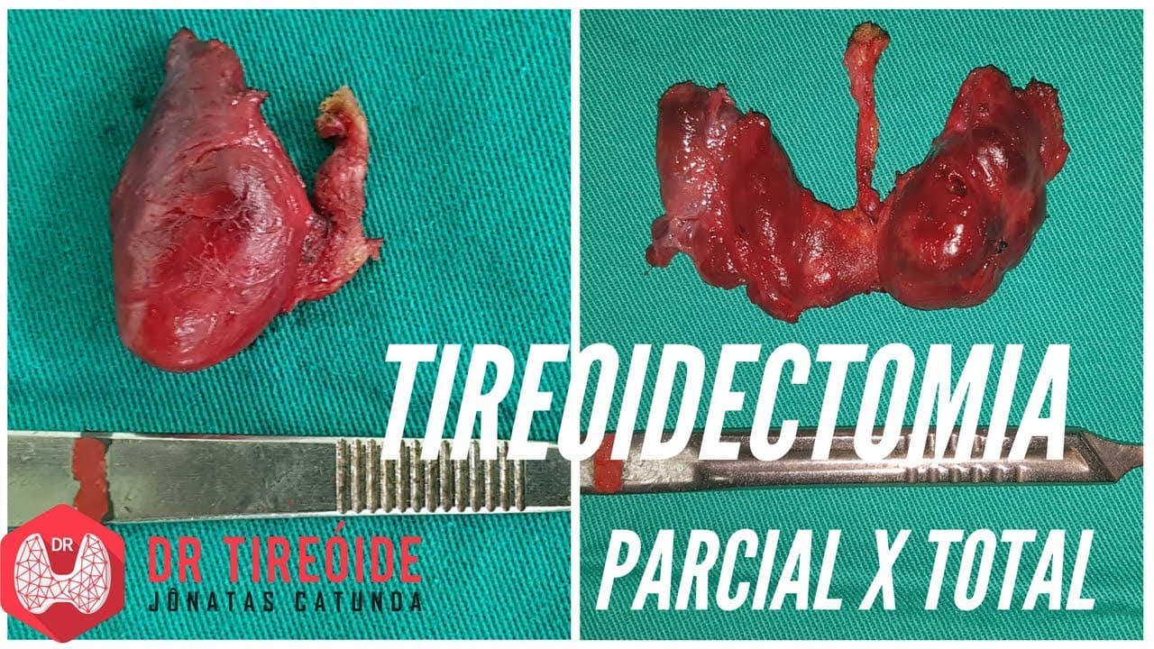 Tireoidectomia parcial ou Tireoidectomia total? | Dr Jônatas Catunda