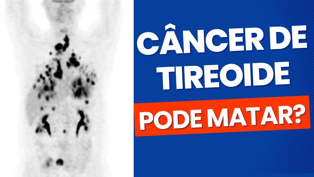 Câncer de tireoide pode matar? Entenda quais as chances!