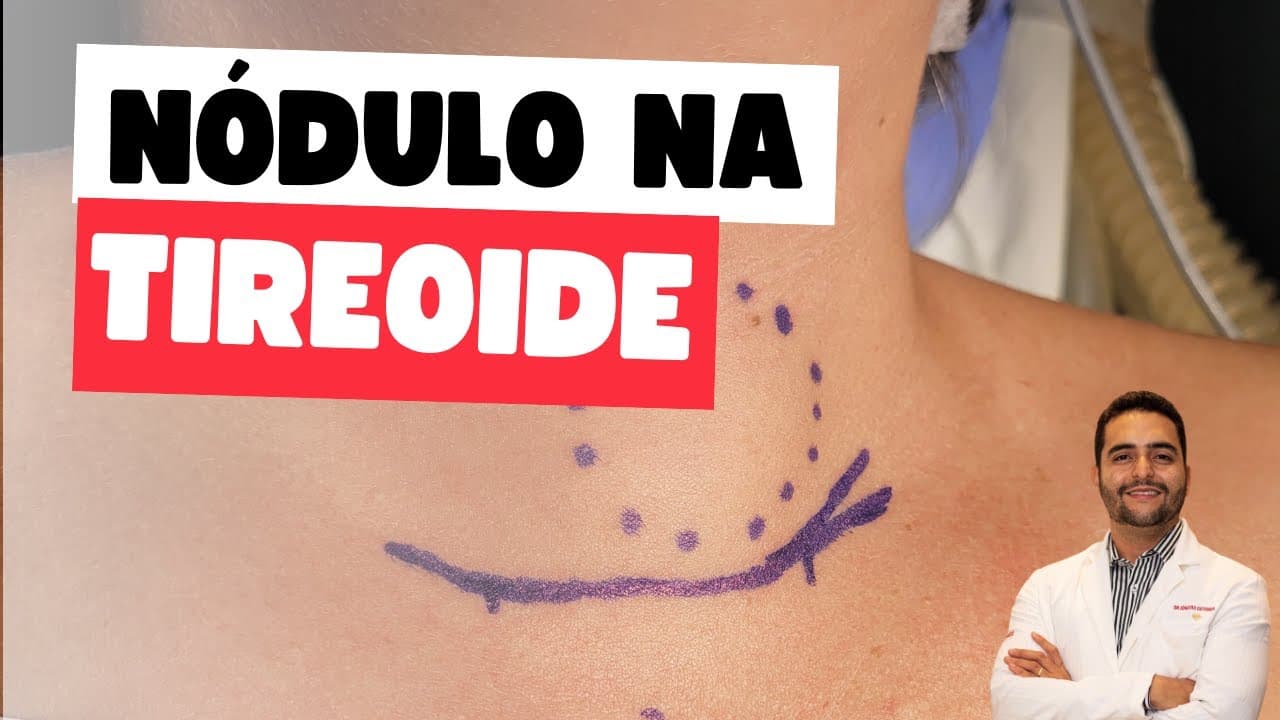 Nódulo na tireóide - 5 situações preocupantes