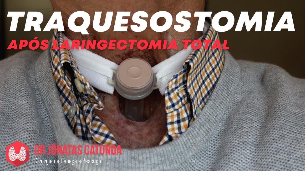 Traqueostomia X Laringectomia total
