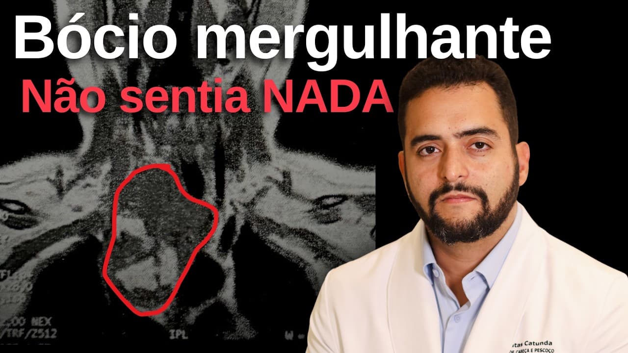 Bócio mergulhante: por que mesmo benigno e sem sintomas tem indicação de cirurgia