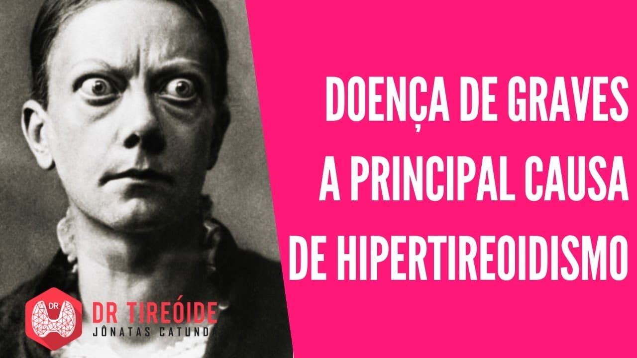 Doença de Graves, a causa mais comum de Hipertireoidismo | Dr Jônatas Catunda