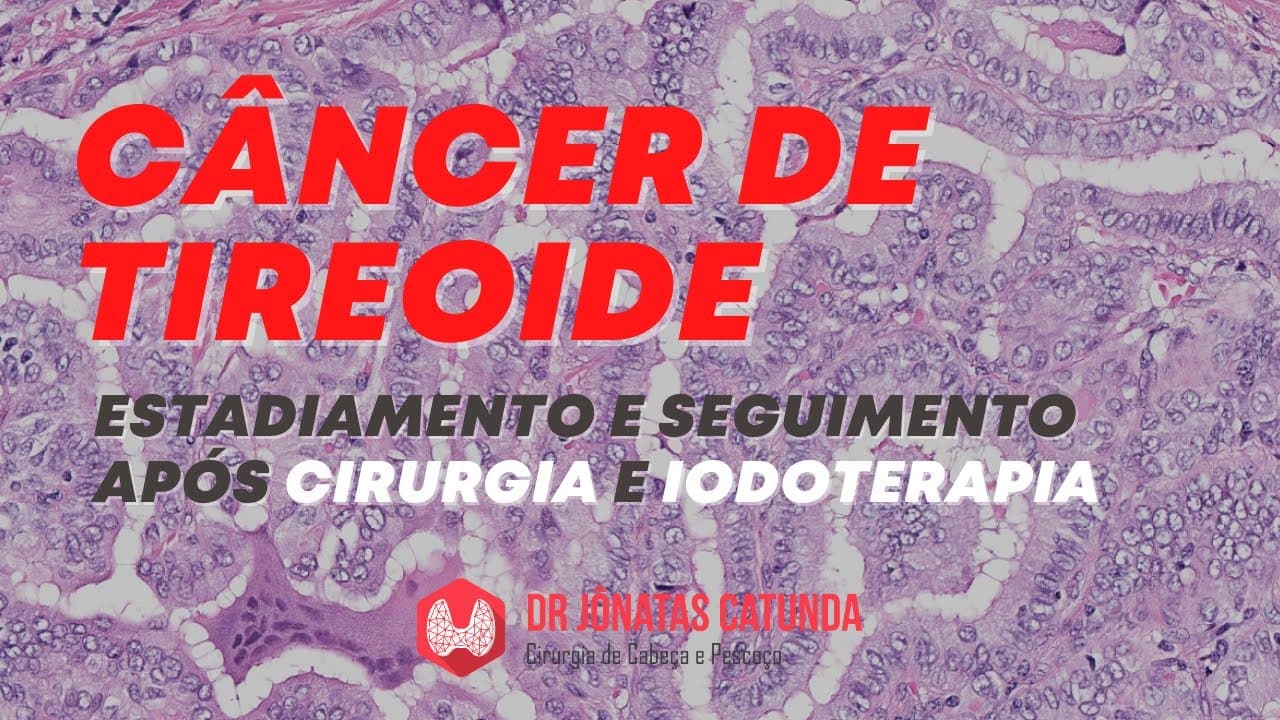 Câncer de tireoide: estadiamento, seguimento e como detectar metástases