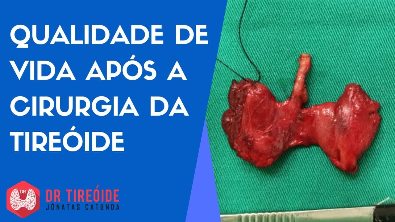 Qualidade de vida após a cirurgia da tireóide