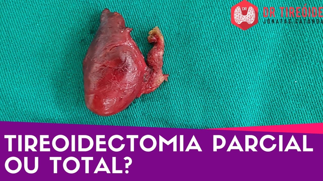 Tireoidectomia parcial ou total? - Dr Tireóide responde