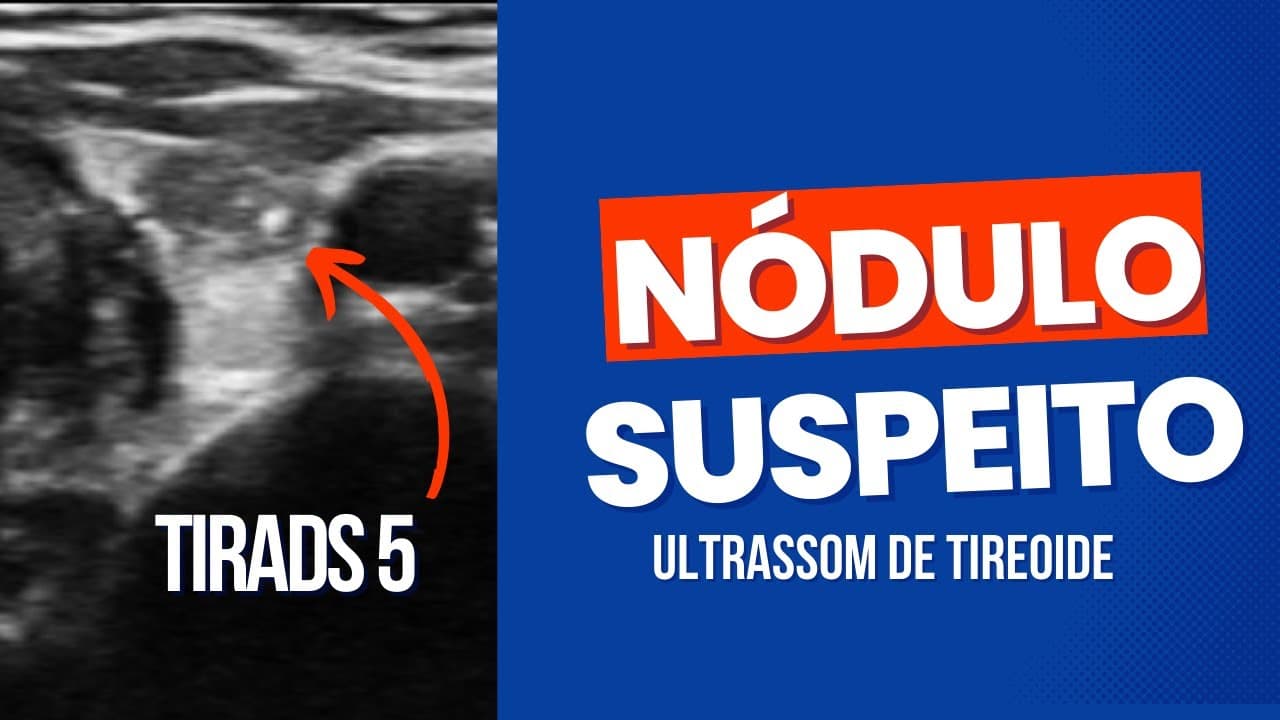 Nódulo na tireóide - características do câncer - classificação Tirads 5 no ultrassom de tireoide