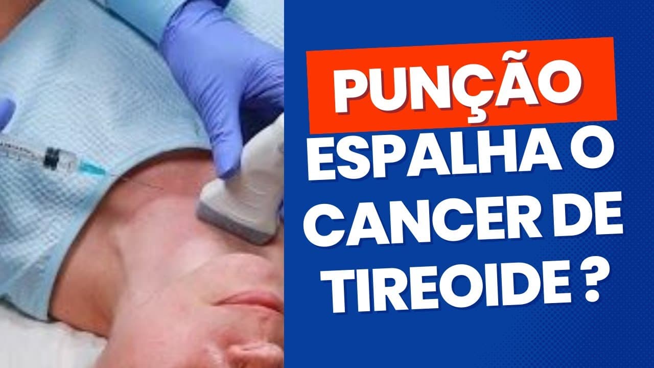 PAAF de nódulo na tireoide pode espalhar o câncer?
