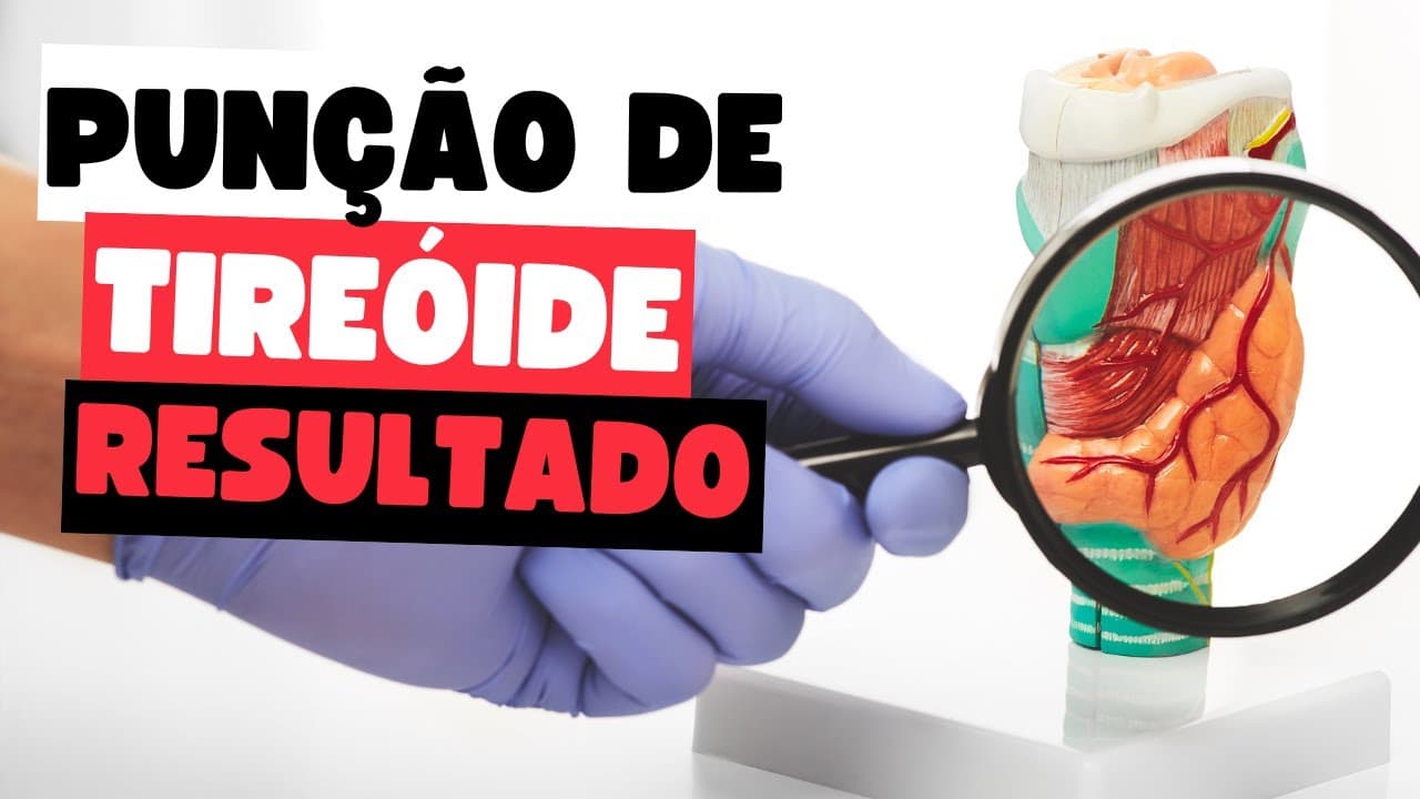 Resultados da PAAF de Tireoide: Como Interpretar? O que significa Bethesda?