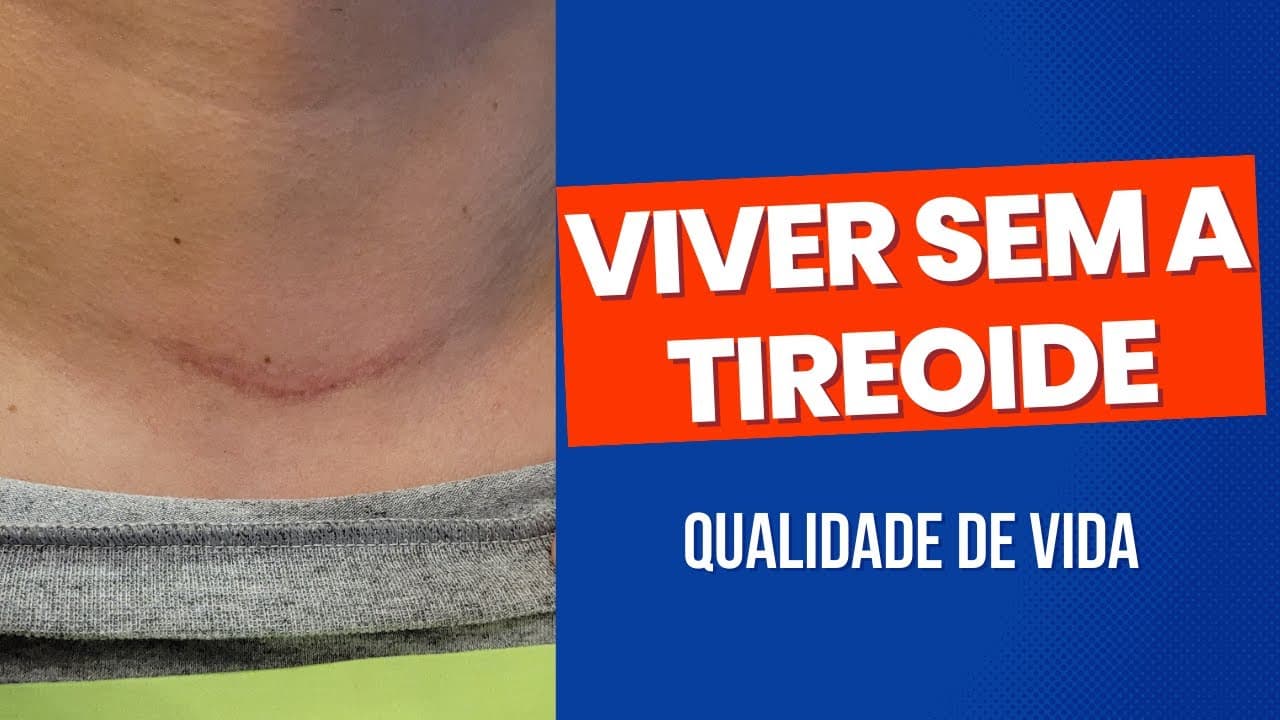 Viver sem a tireoide - é possível ter qualidade de vida?